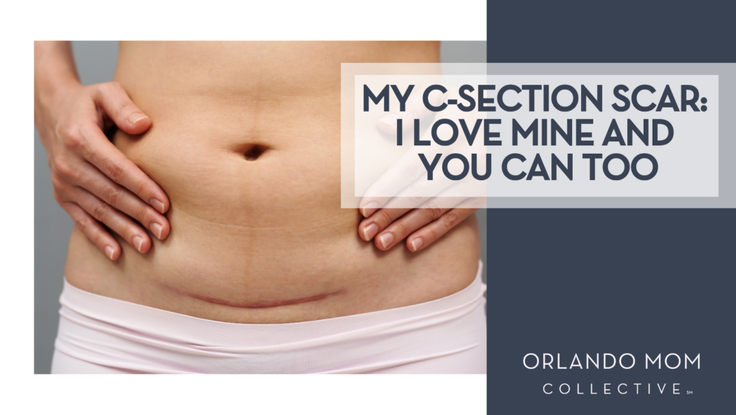 My C-Section Scar I love mine and you can too