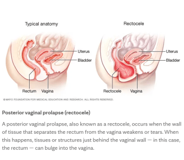 a graphic of what a normal anatomy of the rectum and vagina should look like compared to a prolapsed one. 